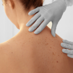 Euromelanoma-veckan 2019 – remissfria besök till hudspecialister